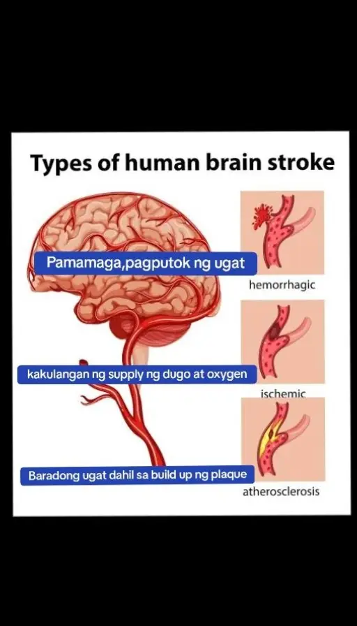 Ano nga ba ang MSS o MAGNESIUM SALT SPRAY? Ito ay pinagsama-samang nga MINERALS,pangunahin ang MAGNESIUM, na inilagay sa isang bote at ipinapahid lang sa BALAT o sa apektadong bahagi,NAPAKALAKI ng kinalaman ng pagkakaroon ng ibat-ibang karamdaman kapag NAWAWALAN ng SAPAT na MINERALS o kaya hindi ito balanse, kaya kapag nabigyan mo ng sapat na minerals ang katawan mo kusang magsisiwalaanbang mga nararamdaman dahil naa-ACTIVATE nito ang NATURAL HEALING MECHANISM,lalo Kong masasabayan ng iba pang mga bitamina lalo ng mayaman sa Bvitamins o Bcomplex,at SAPAT na inom ng tubig,tulog at ehersisyo at makapag paaraw, alisin ang galit sa puso, piliin laging sumaya. Ang kahit anong karamdaman ay maaring GUMALING kapag naibigay mo ang kakailanganin ng iyong katawan. #MSS  #allinone #miraclespray  #NATURALnaPANLUNAS  #MAGNESIUMsaltSPRAY  #naturalnapanlunasadvocate  #pisikpisiktanggalangmgasakit  #TRANSDERMALmineralSUPPLEMENT  #foryou #health #stroke 