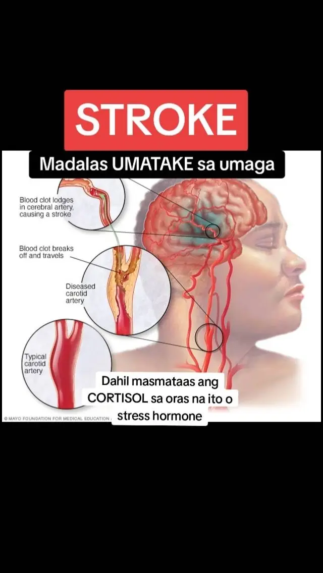 Ano nga ba ang MSS o MAGNESIUM SALT SPRAY? Ito ay pinagsama-samang nga MINERALS,pangunahin ang MAGNESIUM, na inilagay sa isang bote at ipinapahid lang sa BALAT o sa apektadong bahagi,NAPAKALAKI ng kinalaman ng pagkakaroon ng ibat-ibang karamdaman kapag NAWAWALAN ng SAPAT na MINERALS o kaya hindi ito balanse, kaya kapag nabigyan mo ng sapat na minerals ang katawan mo kusang magsisiwalaanbang mga nararamdaman dahil naa-ACTIVATE nito ang NATURAL HEALING MECHANISM,lalo Kong masasabayan ng iba pang mga bitamina lalo ng mayaman sa Bvitamins o Bcomplex,at SAPAT na inom ng tubig,tulog at ehersisyo at makapag paaraw, alisin ang galit sa puso, piliin laging sumaya. Ang kahit anong karamdaman ay maaring GUMALING kapag naibigay mo ang kakailanganin ng iyong katawan. #MSS  #allinone #miraclespray #NATURALnaPANLUNAS #MAGNESIUMsaltSPRAY #naturalnapanlunasadvocate #pisikpisiktanggalangmgasakit #TRANSDERMALmineralSUPPLEMENT #foryou#health#stroke 