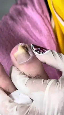 Unha encravada 😱 Ingrown toenail 😱 #unhaencravada #ingrowntoenail #unhacompus #nailwithpus #remocaodeunhaencravada #ingrowntoenailremoval 
