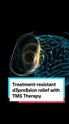 What happens in the brain during depression? And how can TMS (transcranial magnetic stimulation) therapy be used to help treat depression? During depression, the brain isn’t operating at full strength in the area responsible for emotion. Think of it as the brain’s emotional control center. The emotional control center delivers signals along the neural pathways, to and from the areas of the brain that determine how we act, react and respond to situations, thoughts and feelings. In a depressed brain, they have become less active – or even inactive. In other words, signals that would normally regulate mood and emotions do not work properly in depression. This affects the brain’s ability to naturally decode, evaluate and react to what is happening around it. We are excited to utilize the Magventure TMS Therapy® system! ✅ Treatment of Major Depressive Disorder ✅ OCD ✅ Anxiety ✅ PTSD We are offering a free phone consultation with one of our Providers to determine if TMS Therapy is a good treatment option for you. You may call us at 310-270-0625 or email  info@ketamineclinics.com . . . #TMStherapy #transcranialmagneticstimulation #mentalhealthadvocate #MentalHealth #mentalhealthcommunity #mentalhealththerapist #mentalhealthwarrior #mentalhealthwarriors #mentalhealthmatters #traumainformed