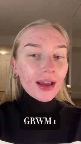 A lack of active pimples is a good reminder to myself that the nasty side effects are well worth the end result of, hopefully, forever good skin! But we’ll see.. #acne #newyork #nyc #newyorkcity #nyccontentcreator #contentcreator #goals #nycinfluencer #accutane #insecurity #anxiety #columbia #columbiastudent #columbiauniversity #motivation #wellness #skincare #relatable #skincaretips #accutanejourney #accutanediary #selflove #confidence #bodypositivity #dry  #grwm #dryskin 