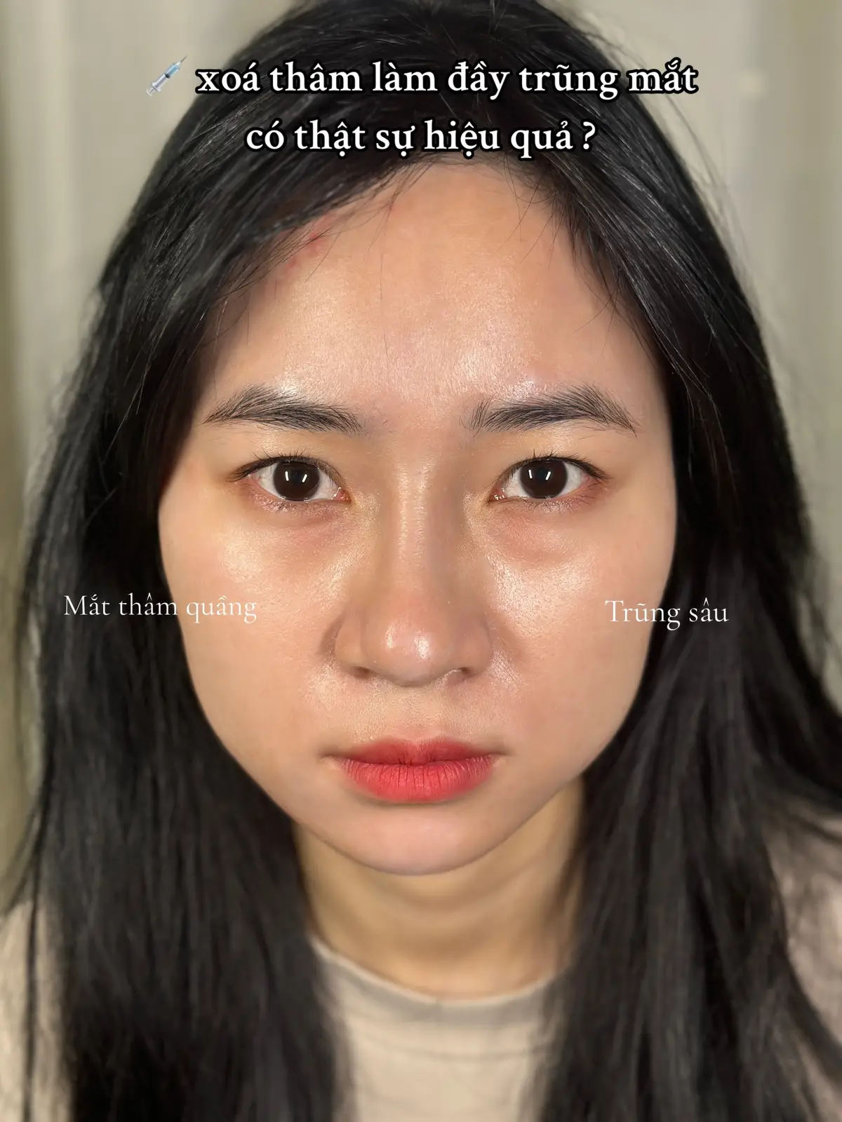 Ai còn để trũng mắt thâm quầng thì xem ngay nèee #trending #fyp #xuhuong #foryou #filler #botox #lipfiller #tiemfillerdep #beautyboxbymei 