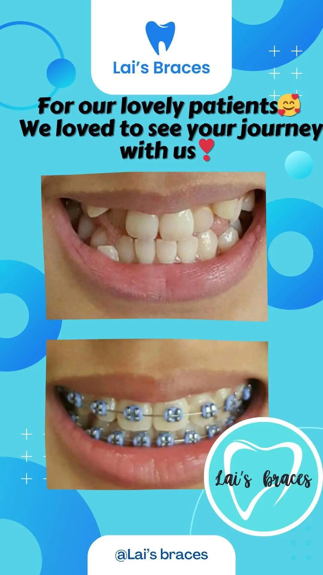 Please share your journey with us in the comments section🥳❣️ IMPORTANT‼️  Please be advised for our official pages🥰 ✅Lai's braces ✅Lai’s Denture ✅Lai’s Braces HONG KONG and our only official group Lai’s Braces #taoyuan #taoyuantaiwan #taoyuan_taiwan🇼🇸🇻🇳 #taoyuan_taiwan🇹🇼 #taoyuantransient #everyone #brace #bracestaiwan #foryoupage #foryou #braces #bracestaiwanneili #bracestips #bracescheck #foryoupage #fyp #taiwan #foryou #kaohsiung_taiwan🇹🇼🇲🇨 #pustiso #taiwantiktokers #zhongli #neili #braceneili #denture #dentures #braceshack #dentures 