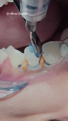 Composite restoration of anterior teeth #dentist #teeth #dentista #dental #dentistry 