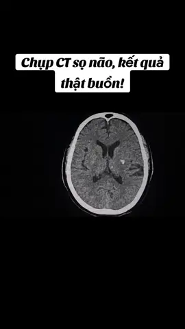 Bệnh nhân đến khám cấp cứu, chụp CT sọ não, không những buồn 1 mà buồn tận 2, nhưng dù sao cũng đã phát hiện bệnh! #CT #mri #suckhoe #sức_khỏe_là_vàng 