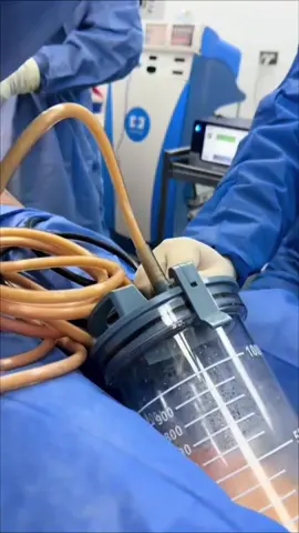 Transferencia glutea 🤩 #doctorapacia #belleza #venezuela #resultados #maracay #cirugiaplastica #lipotransferecia #transferenciaglutea 