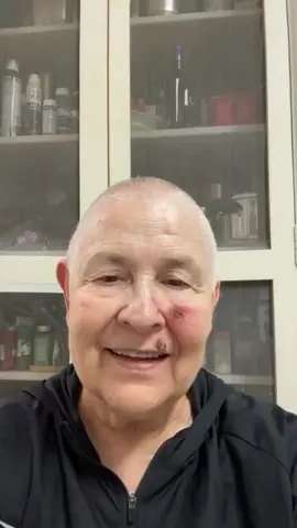 Monja Cohen revelou que está em tratamento contra um câncer de pele. Em seu Instagram, ela tranquilizou seus seguidores e disse que está em processo de cura. Em paz e repleta de bom humor, ela contou que está realizando as sessões de quimioterapia. 🎥: Instagram