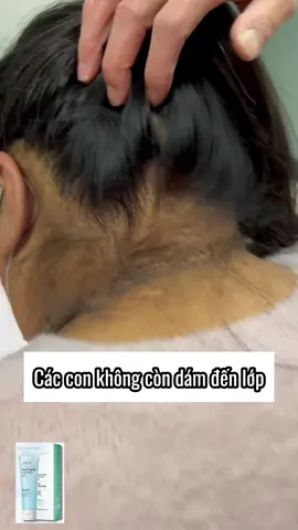 Cổ đen khiến các con tự ti, không dám giao lưu với bạn bè  #gaiden #trangdaco #duongtrangda