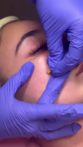 Extractions 🤩 #facialextractions #extractions #pimplepopperaddict #skincare #extractionfacial #pimpleremover 