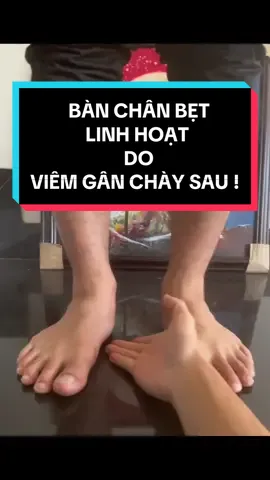 Viêm gân chày sau gây ra bàn chân bẹt thứ phát có thể khắc phục được!! #viemganchaysau #banchanbet #flexibleflatfoot #posteriortibialtendonitis #runner