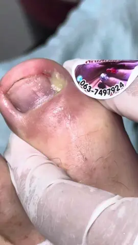 Unha encravada 😱 Ingrown toenail 😱 #unhaencravada #ingrowntoenail #unhacompus #nailwithpus #remocaodeunhaencravada #ingrowntoenailremoval