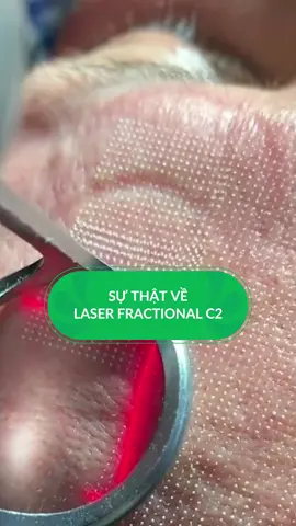 Phương pháp trị sẹo, căng mịn da được chị em tin yêu nhất hiện nay: Laser CO2 #bsthuythucuc #skincare #reviewlamdep #glowyskin #laser #laserco2 