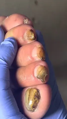 #nails #nail #toenail 