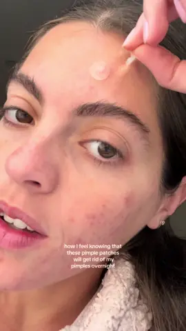 Your sign to invest in the lifesaving @Hero Cosmetics pimple patches 🥹🫧🧚🏼 #pimplepatch #pimplepatches #pimplepatchremoval #acne #acnefighter #acnetips #acnehelp #acnesiin #pimple #relatable #fyp #selflovebestlove 