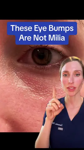 Common mix up. #milia #clearskin #eyebumps #miliatreatment #retinol #dermtok #skintok