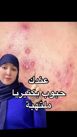 #حبوب #حبوب_بكتيريا #حبوب_ملتهبة #حب_الشباب #حب_الشباب_وأثاره #حبوب_تحت_الجلد #ساليساليك_اسيد #تريتينوين #panoxyl #tretinoin #salycilicacid #acne #acnetreatment #البشرة_الدهنية #البشرة_الحساسة #عنايه #عناية_بالبشرة #حبوب_الوجه #حبوب_الظهر #حبوب_الصدر #اورديناري #بديل #بشرة #بشرة_صحية #بشرة_صافية #بشرة_نضرة #مقشر #مقشر_احماض_فواكه#retacnyl #skincare #skincareroutine #سكين_كير #fyp #fypシ #fypシ゚viral #explore #explor #explorepage #trending #foryou #foryou #tiktok #maroco🇲🇦algeria🇩🇿tunisia🇹🇳 #viral #viralvideo #viraltiktok #parfumerie_amina #حركة_الاكسبلور #اكسبلور #اكسبلورexplore #الشعب_الصيني_ماله_حل😂😂 #المغرب🇲🇦تونس🇹🇳الجزائر🇩🇿 #المغربيات_أجمل_نساء_الكون🇲🇦مغربية #المغرب🇲🇦تونس🇹🇳الجزائر🇩🇿تركيا🇹🇷_العراق🇮🇶 #عطور_أمينة #الخليج_العربي_اردن_عمان_مصر_تونس_المغرب #مشاهير_تيك_توك #تيك_توك #girl #skincare #سكين_كير #مشاهير #مشاهدات #مسامات_واسعة##mielleorganics #الاكرتين