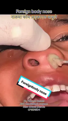 #foreignbodynose #viral #foryou #fypシ゚viral #trending #entdoctorbutwal #fyp #entdoctor 