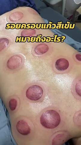 สีเข้มๆของรอยครอบแก้ว บ่งบอกอะไร? #ครอบแก้ว #ปวดหลัง #ออฟฟิศซินโดรม #แพทย์แผนจีน #หมอจีน #ครอบแก้วรักษาอาการปวด #ครอบแก้วอ่อนนุช #ปวดคอบ่าไหล่ #ฟาจินคลินิก 
