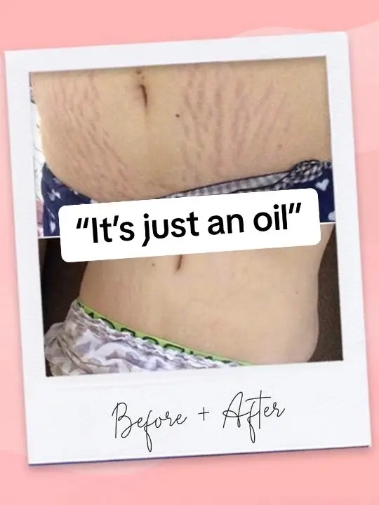 Our oil is both eliminative and preventative against stretch marks, scars and many other skin imbalances ⚡️ Before and afters on our website #meiskin #stretchmarks #stretchmarkremoval #scarremoval