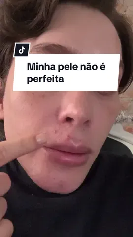 Minha pele não é perfeita e a de ninguém é. Vamos bater um papo sobre autoestima e pele.  #skincare #skinarmy #foryou 