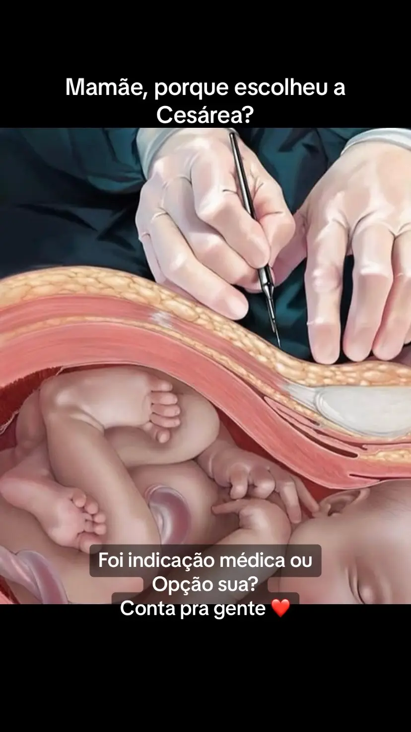 Cesaréa #cesarea #cesariana #gravidez #partocesarea #mamae #viraliza 