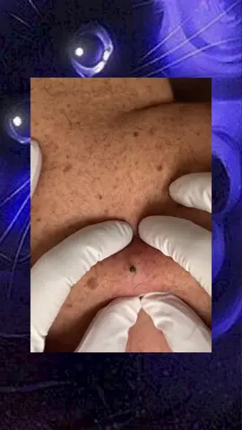 #squeeze  #squeezeyuk  #acne  #pimple  #pimplepop  #blackhead  #satisfying  #foryoupage
