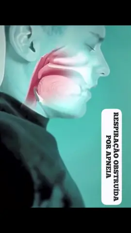A apneia do sono é um distúrbio caracterizado por pausas na respiração ou respiração superficial durante o sono. Essas pausas podem ocorrer várias vezes por hora e podem levar a sintomas como sonolência diurna, fadiga, irritabilidade, dificuldade de concentração e até mesmo problemas de saúde mais graves, como hipertensão arterial e doenças cardíacas.Existem dois tipos principais de apneia do sono: a apneia obstrutiva do sono, causada pela obstrução das vias respiratórias, e a apneia central do sono, causada por uma falha na comunicação entre o cérebro e os músculos responsáveis pela respiração.O tratamento da apneia do sono depende do tipo e da gravidade da condição. Pode incluir mudanças no estilo de vida, como perda de peso, evitar o consumo de álcool e tabaco, dormir de lado em vez de de costas, e uso de aparelhos como o CPAP (pressão positiva contínua nas vias aéreas) para manter as vias respiratórias abertas durante o sono. Em alguns casos, cirurgia pode ser recomendada para corrigir obstruções nas vias aéreas.  #apneiadosono #fisioterapia #cpap #apneiaobstrutivadosono #fisioterapeuta #fisio #fh♿️ 