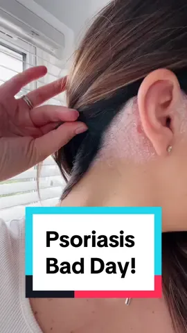 Psoriasis BAD day! ##psoriasis##skincare##skin##dermatologist##fyp##help##foryou##foryourpage##viral##dailyvlog##mumsoftiktok