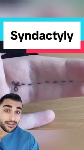 #medicine #medical #medtok #medicaltiktok #syndactyly 