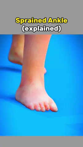 sprained ankle medical animation 3D #sprainedankle #ankle #anklesurgey #medicalanimation 