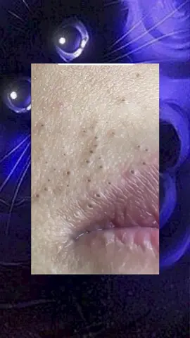 #squeeze  #squeezeyuk  #acne  #pimple  #pimplepop  #blackhead  #satisfying  #foryoupage