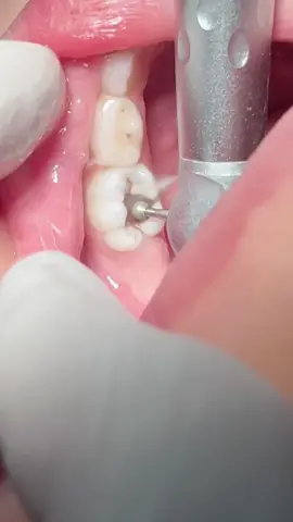 Deep tooth caries in 4 years old girl , she was so brave 👍😎🤗 #dentist #dentista #dental #usa 