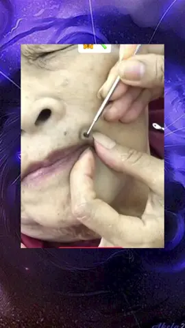 #squeeze  #squeezeyuk  #acne  #pimple  #pimplepop  #blackhead  #satisfying  #foryoupage