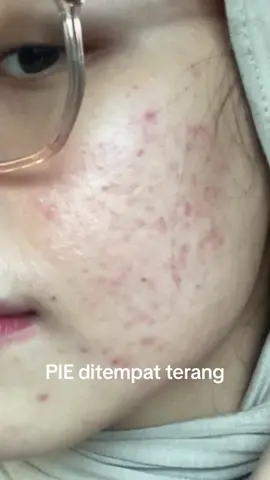 musuhnya PIE itu matahari😞  #pie #redness #acneskin #acneproneskin #acnefighter #pih #acnescars #hormonalacne 