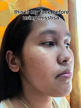 super worth it talaga ng misstisa! grabe yung glow after mo sya gamitin😍❤️ #melasma #misstisa #melasmatreatment #matildasbeauty #rejuvenatingset #hyperpigmentation #pekas #skincare #foryoupage 