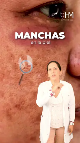 Elimina las manchas con Láser Starwalker ✨😊 ⛔ Las manchas son un problema común que afecta a personas de todas las edades. Pueden ser causadas por exposición solar, cambios hormonales, envejecimiento o factores genéticos. ❇️ ¡La solución! Láser Starwalker es una tecnología de última generación que elimina las manchas de forma precisa y controlada . . #manchas #piel #láser #láserstarwalker #tratamientos