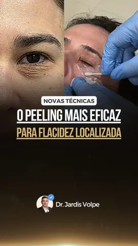 Realizando um RESET com o Peeling Localizado! Esse procedimento do vídeo promove a troca da sua pele envelhecida. Através de uma avaliação precisa, conseguimos tratar áreas como: Pálpebras superiores e inferiores ✅ Bolsas nos olhos ✅ Rugas ✅ Flacidez ✅ ⚠️ Obs.: O Peeling de Cróton é diferente do fenol tradicional! Tem uma rápida recuperação (aprox. 7 a 10 dias) e é feito em consultório. Para mais informações o nosso WhatsApp é o (11) 98508-1187. A Clínica está localizada na R. Bento de Andrade, 431 - Jardim Paulista, São Paulo.  #peelinglocalizado #peeling #peelingdecroton #blefaropeeling #pálpebras #croton #rugas #pele #colageno #rugasdinamicas #olhar #pédegalinha #boca #rugasestáticas #códigodebarras #skincare #tratamentofacial #olhos #estetica #manchas 