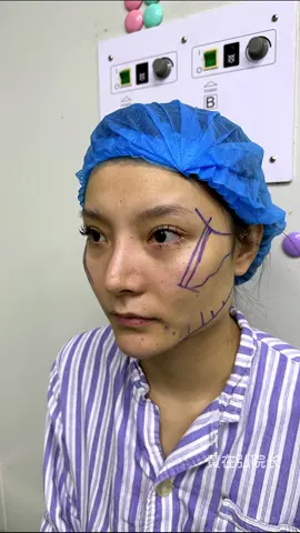 磨骨日常#磨骨 #整形 #变美