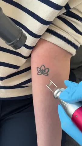 Bye Tattoo 🌷💛 #tattooremoval #fyp #satisfying #asmr #picoplus #detatouage #laser #picolaser 