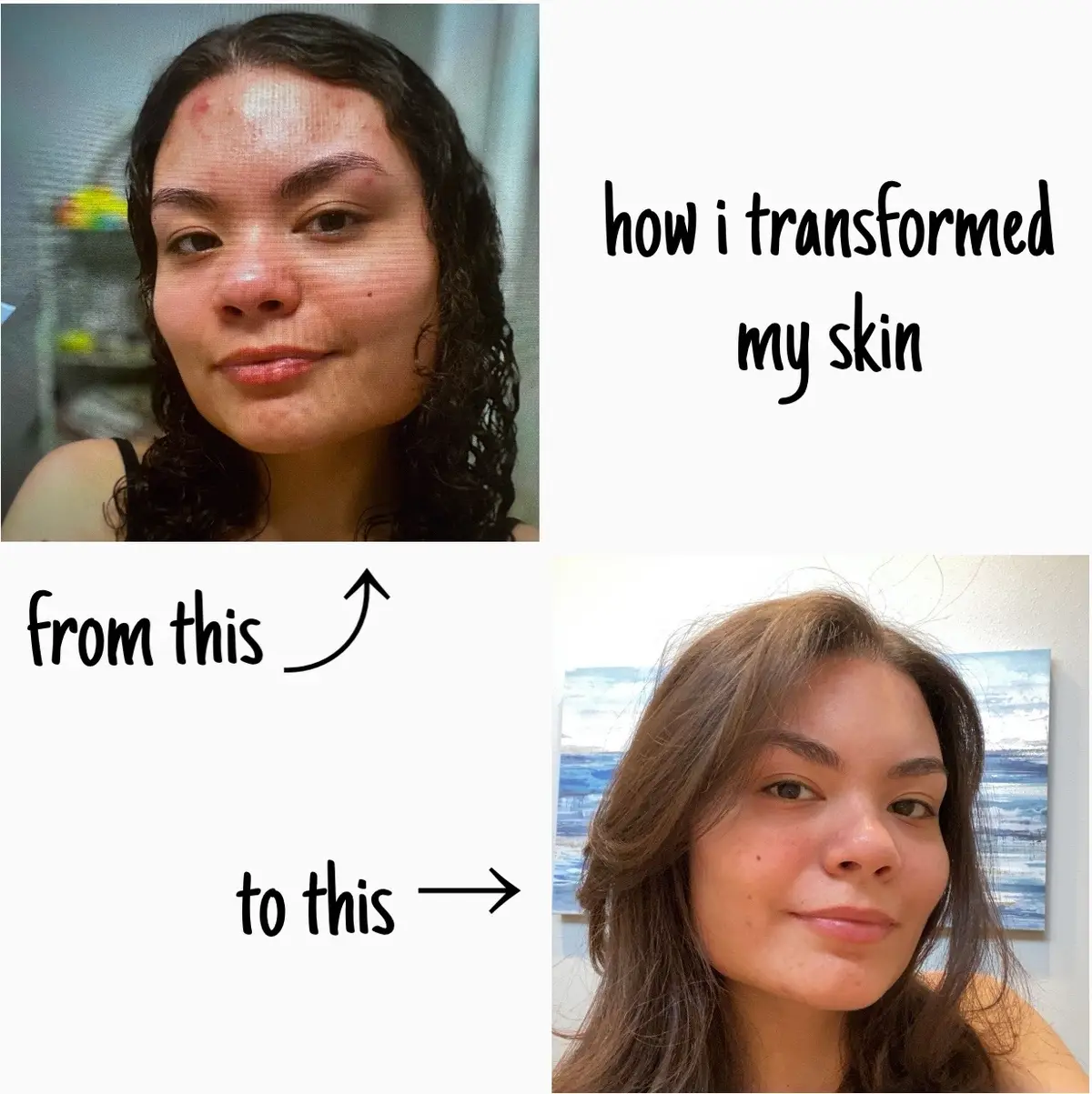 Lots of trial and error, but i finally have found what works. 🤍 #routine #skincareroutine #skincare #acne #acnejourney #skin #skincarejourney #skincareaesthetic #health #healthyskin #journey #theordinary #cerave #clindamycin #benzoylperoxide #clindamycinphosphate #clindamycinbenzoylperoxide #rhode #rhodeskin #neutrogena #sunscreen #suncare #skincareaesthetic #niacinamide #theordinaryskincare 