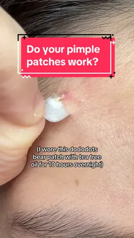 Replying to @shopiifter these pimple patches suck 🫣 #dododots #dododotspimplepatches #tiktokshop #acne #skincare 
