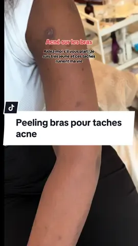 🙏🏿👉🏾Le peeling éclaire Zepharma⚜ Peeling organique + compose avec cocktel vitamines + sérums adapté à votre problématique de peau‼️ ##peelingskin##peelingfacial##peelingquimico##beautiful##beauty##zepharma ##zepharmabeaute##serumbioessence##serumbotox##serumacne##acide##acidehyaluronique##acidefacil##bellepeau##soinsvisage##soinvisage##soinnaturel##soinsnaturels##soincorps##hydroquinone