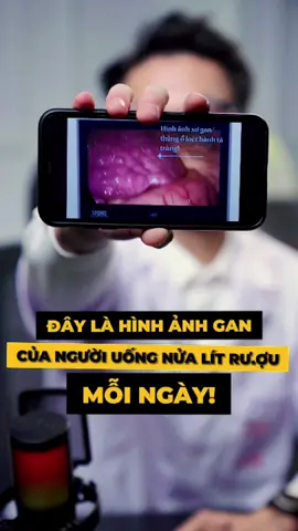 Điều gì xảy ra với gan khi uống r.ượu thường xuyên #LearnOnTikTok #gan #uongruou #bienhoclambacsi #bacsibienn 