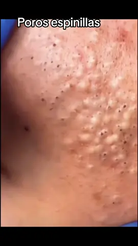 #extractions #puntosnegros #acne #grasa #espinillas #granos #poros #pelo #Folículo #relajante #facial #extraccion 