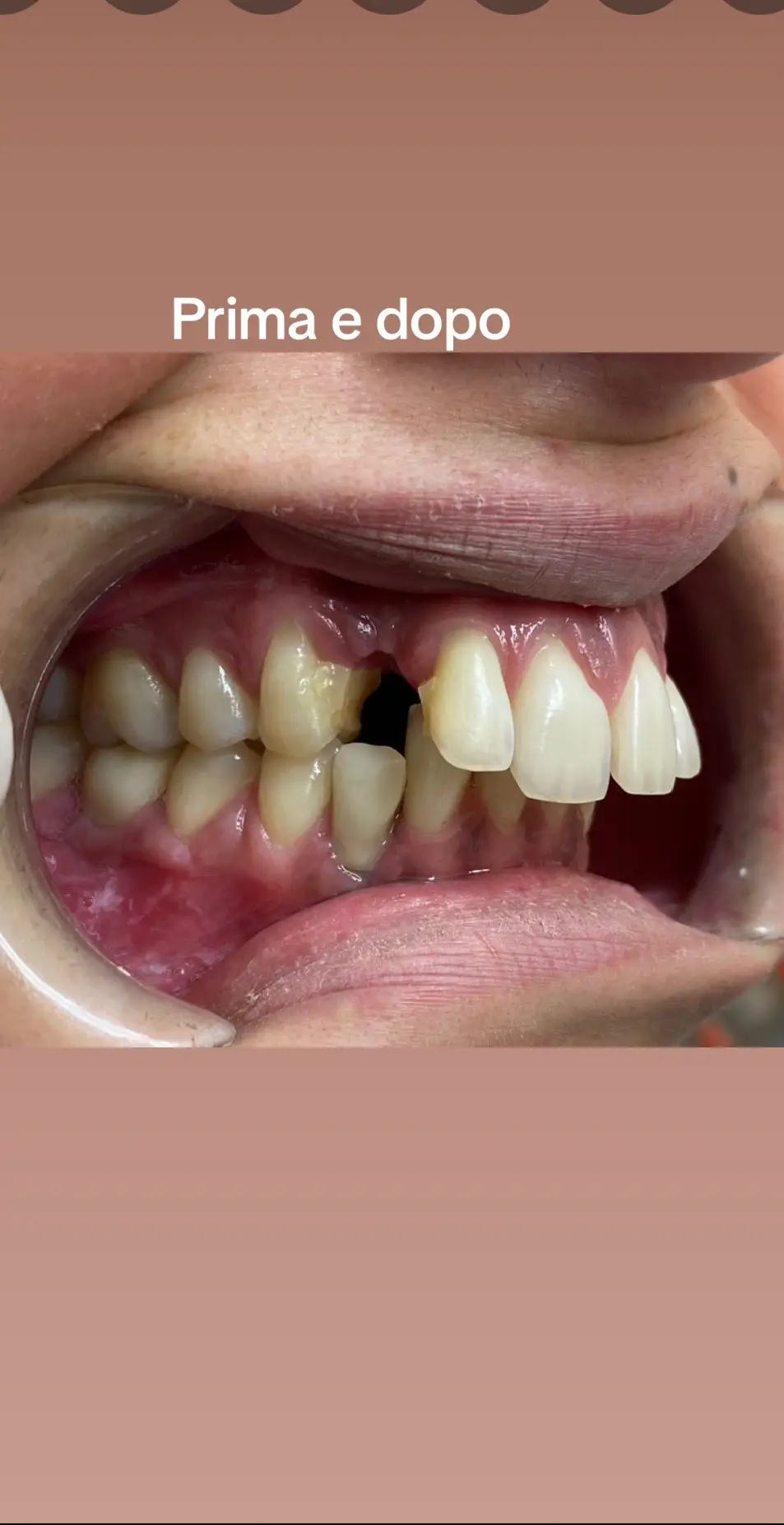 🦷#Ecco un proma e dopo e il Paziente ritorna a sorridere 🦷Facci sapere cosa ne pensi nei commenti  #dentista #faccettedentali #luminners #sbiancamento #napoli 