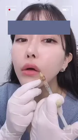 🔺 Lip Fillers for korean style 🔺 ✅ Make a smile line on the corners of your mouth ✅ The ratio of the upper and lower lips to 1:1.5 golden ratio    