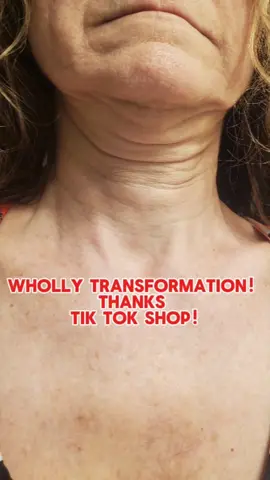 10 Years Younger! #tiktokfinds #tiktokflashsale #tiktokshop #tiktokshopdeals #fyp #tiktokspringsale #Gopure #skincare #necklift @Gopure 