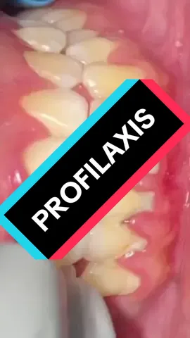 Limpieza dental con untrasonido, les relaja ver como se realiza?#dentista #dentist #odontologia #limpiezadental #dientesblancos #denstitasentiktok 