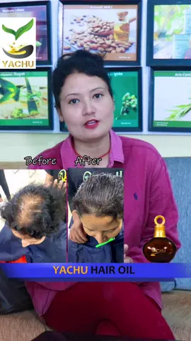 Fulfill Your dream to Having healthy hair with the best organic product of Nepal “Yachu Hair Oil” you can see the result of our customer after having Yachu treatment… #yachu #fyp #tiktok #tiktoknepal #viral #foryou #fyp 