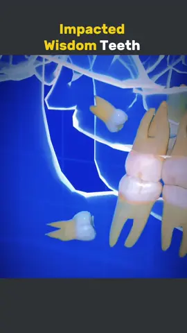 Wisdom Teeth Extraction Process 3D Animation  #wisdomteethremoval #wisdomteethextraction #wisdomteethsurgery #wisdomtooth #teethsurgery #dentalprocedure 